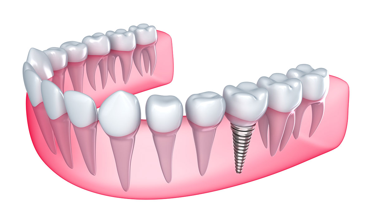 Implantology