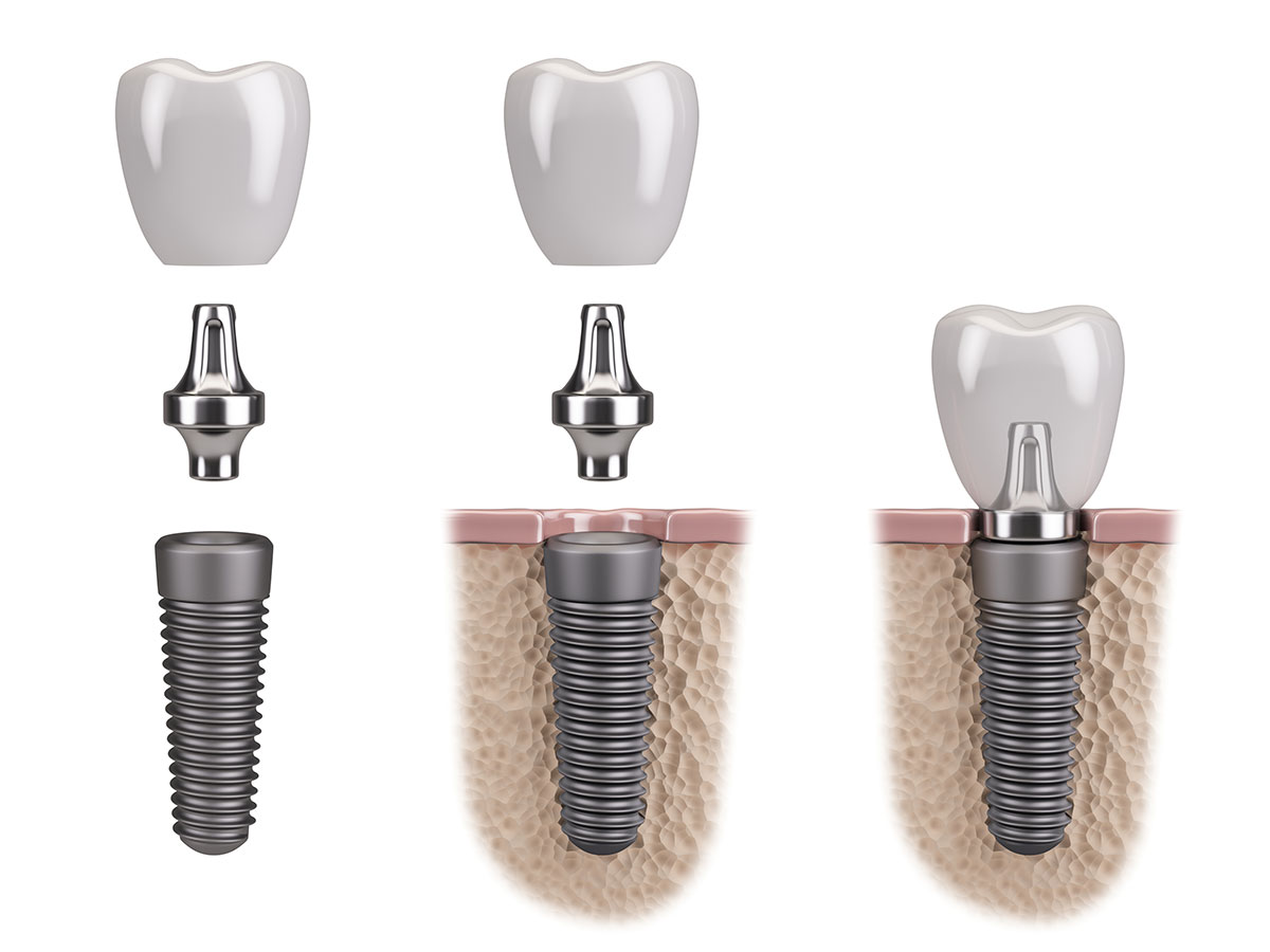 Implantology