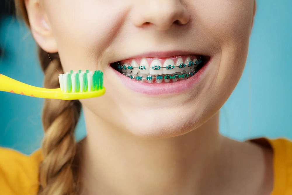 >Metal Braces Systems