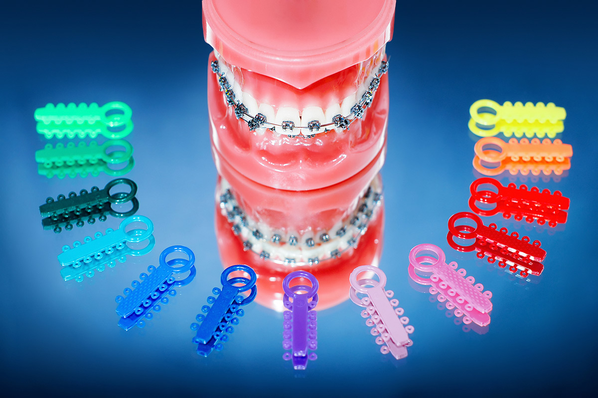 >Metal Braces Systems