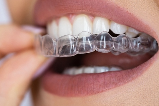 Now at GMS Dental: Revolutionary Angel Aligner Technology for the Perfect Smile